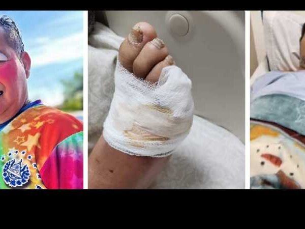 Cocolito reaparece tras amputación de su dedo del pie y muestra su recuperación